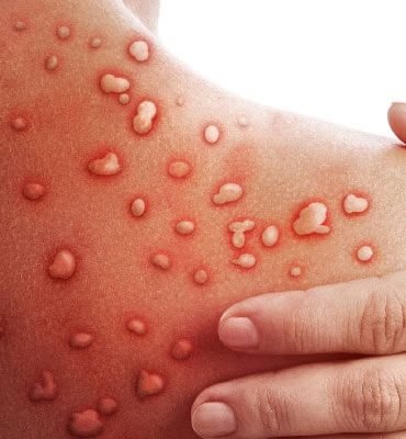 Maymun Çiçeği Virüsü