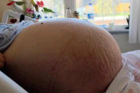 Karnindaki-sisligi-kabizlik-sandi-22-kiloluk-tumor-cikti-featured